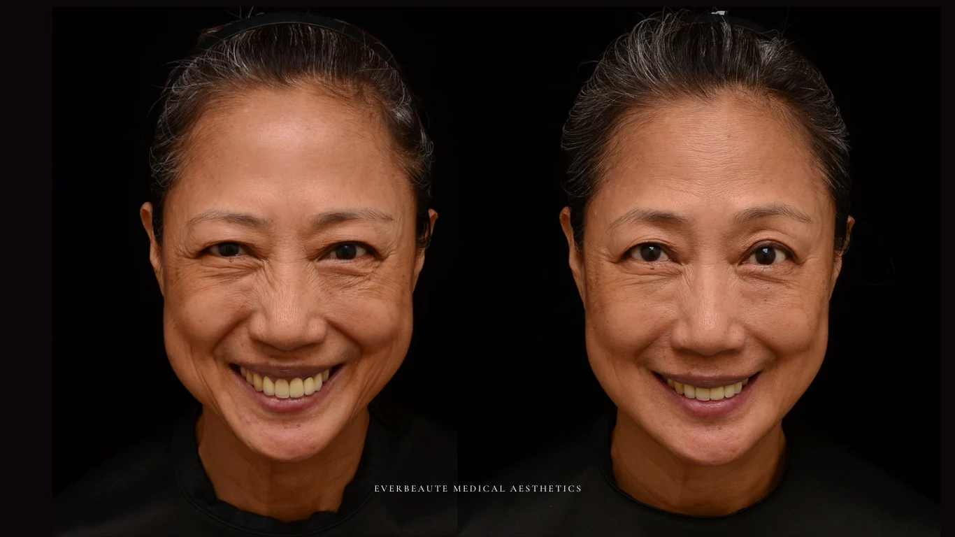 台北醫美推薦 大安區醫美 桃園微整 淚溝 眼袋 黑眼圈 木偶紋 蘋果肌 印地安紋 貓咪紋 嘴邊肉下垂 非手術 無痕拉提 凝境美學診所 曾繁聞醫師 于曉恩醫師 皮膚科 專科 專業 效果自然 微整形 填補 填充 瑞士緹奧希 玻尿酸 喬雅登 水無痕 保柔緹 女神動態 熊貓針 淚溝針 童顏針 伊蓮絲 精靈針 喬雅露 逆時針 價格 副作用 後遺症 dcard ptt 成功案例 7