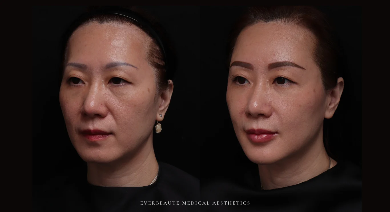 台北醫美推薦 大安區醫美 桃園微整 淚溝 眼袋 黑眼圈 豐唇 木偶紋 太陽穴凹陷 蘋果肌 印地安紋 貓咪紋 嘴邊肉下垂 非手術 無痕拉提 凝境美學診所 曾繁聞醫師 于曉恩醫師 皮膚科 專科 專業 效果自然 微整形 填補 填充 瑞士緹奧希 玻尿酸 喬雅登 水無痕 保柔緹 女神動態 熊貓針 淚溝針 童顏針 伊蓮絲 精靈針 喬雅露 逆時針 價格 副作用 後遺症 dcard ptt 成功案例