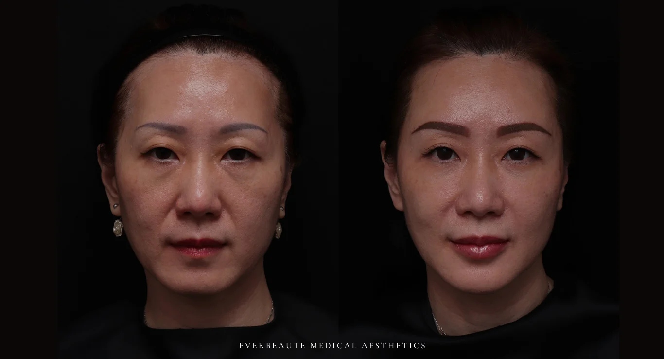 台北醫美推薦 大安區醫美 桃園微整 淚溝 眼袋 黑眼圈 豐唇 木偶紋 太陽穴凹陷 蘋果肌 印地安紋 貓咪紋 嘴邊肉下垂 非手術 無痕拉提 凝境美學診所 曾繁聞醫師 于曉恩醫師 皮膚科 專科 專業 效果自然 微整形 填補 填充 瑞士緹奧希 玻尿酸 喬雅登 水無痕 保柔緹 女神動態 熊貓針 淚溝針 童顏針 伊蓮絲 精靈針 喬雅露 逆時針 價格 副作用 後遺症 dcard ptt 成功案例 台北醫美