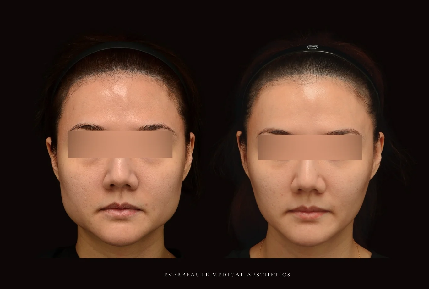 肉毒小臉-瘦臉-咬肌-咀嚼肌 凝境美學診所 于曉恩醫師 曾繁聞醫師 大安區醫美 台北醫美2