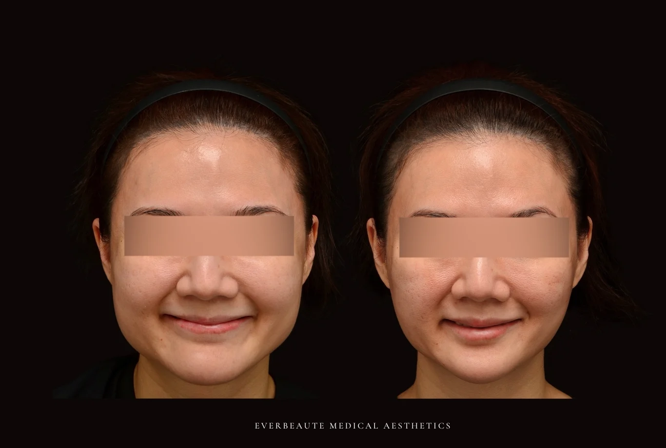 肉毒小臉-瘦臉-咬肌-咀嚼肌 凝境美學診所 于曉恩醫師 曾繁聞醫師 大安區醫美 台北醫美1