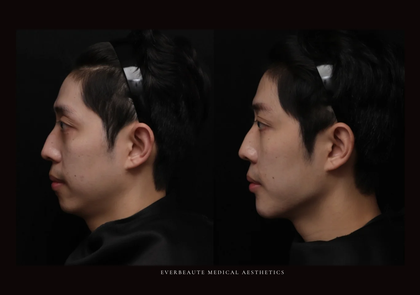 凝境美學診所 院長案例 台北醫美 大安區診所 曾繁聞 于曉恩 肉毒 拉提