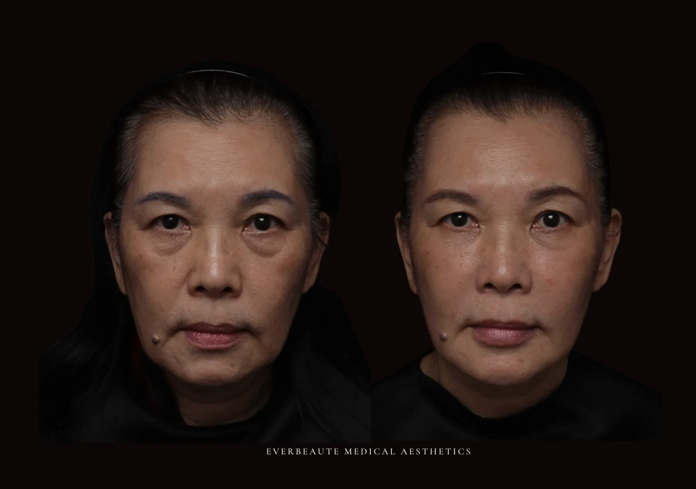 艾麗斯 AestheFill 俗稱精靈針 凝境美學院長教學案例