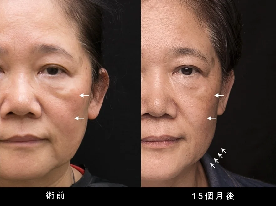 鳳凰電波 凝境美學 曾繁聞醫師 于曉恩醫師 台北醫美 大安區 緊緻拉提1 輪廓線 眼周鳳凰電波 凝境美學 曾繁聞醫師 于曉恩醫師 台北醫美 大安區 緊緻拉提1 輪廓1