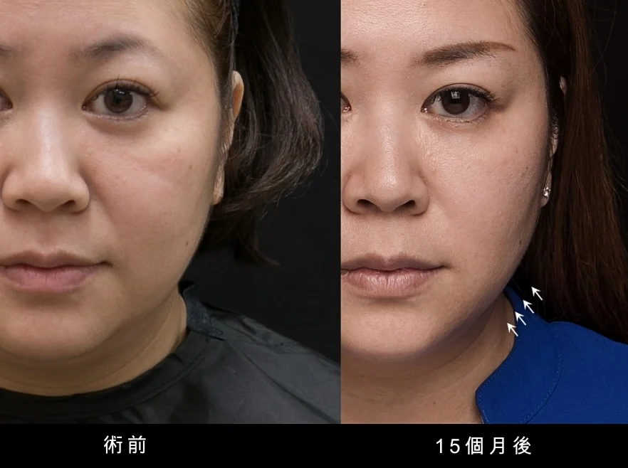 鳳凰電波 凝境美學 曾繁聞醫師 于曉恩醫師 台北醫美 大安區 緊緻拉提1 輪廓線 眼周鳳凰電波 凝境美學 曾繁聞醫師 于曉恩醫師 台北醫美 大安區 緊緻拉提1 輪廓2