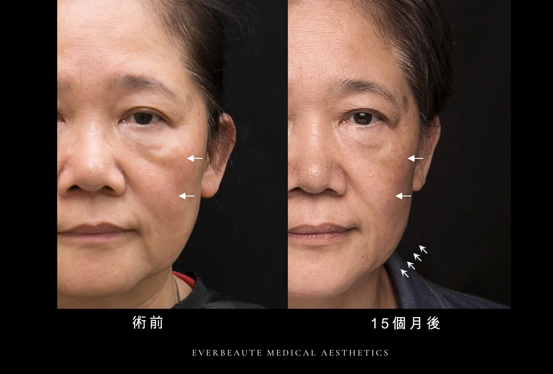 鳳凰電波 凝境美學 曾繁聞醫師 于曉恩醫師 台北醫美 大安區 緊緻拉提1 輪廓線 眼周細紋