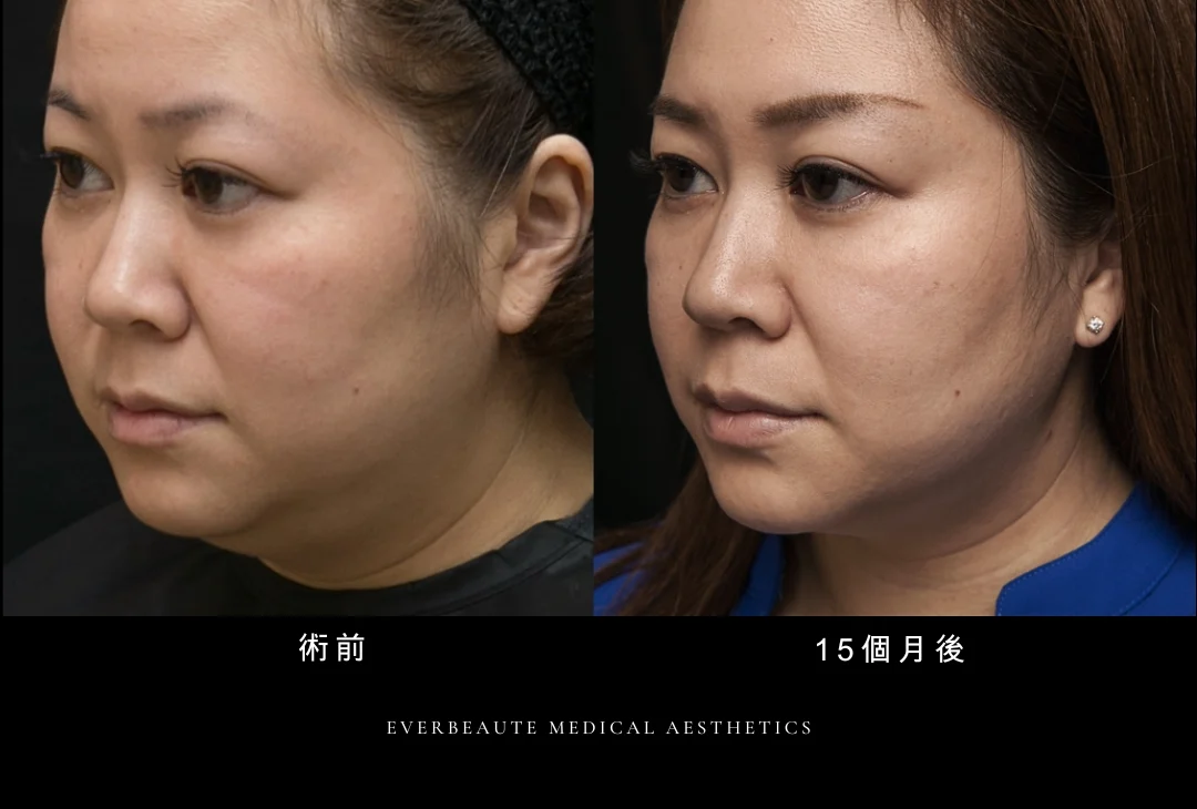 鳳凰電波 凝境美學 曾繁聞醫師 于曉恩醫師 台北醫美 大安區 緊緻拉提3 鳳凰電波 凝境美學 曾繁聞醫師 于曉恩醫師 台北醫美 大安區 緊緻拉提2 鳳凰電波 凝境美學 曾繁聞醫師 于曉恩醫師 台北醫美 大安區 緊緻拉提5 鳳凰電波 凝境美學 曾繁聞醫師 于曉恩醫師 台北醫美 大安區 緊緻拉提4 輪廓線 眼周細紋