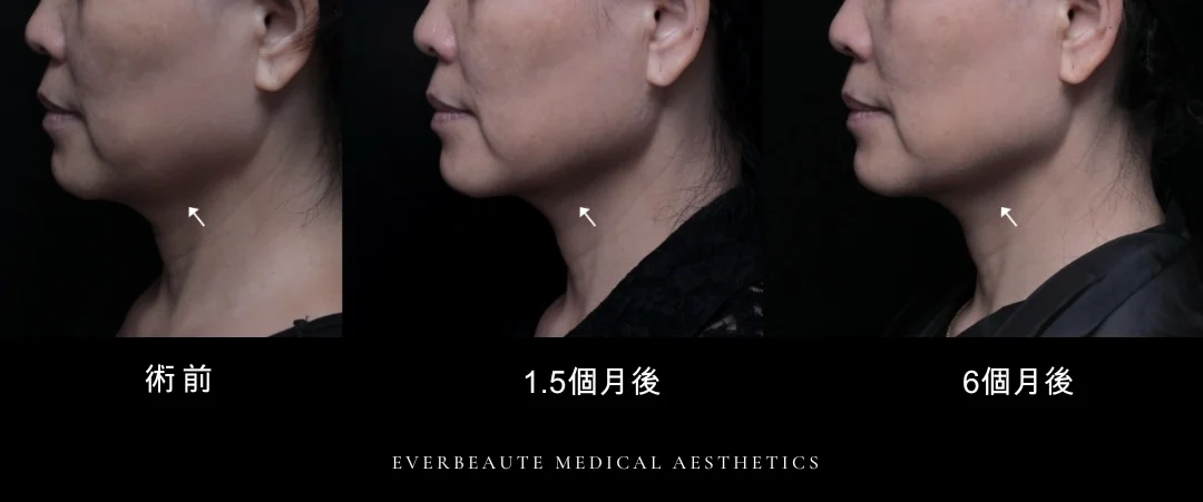 鳳凰電波 凝境美學 曾繁聞醫師 于曉恩醫師 台北醫美 大安區 緊緻拉提4 輪廓線 眼周細紋