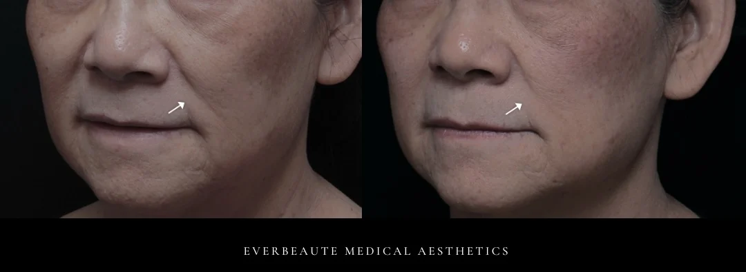 鳳凰電波 凝境美學 曾繁聞醫師 于曉恩醫師 台北醫美 大安區 緊緻拉提5 鳳凰電波 凝境美學 曾繁聞醫師 于曉恩醫師 台北醫美 大安區 緊緻拉提4 輪廓線 眼周細紋