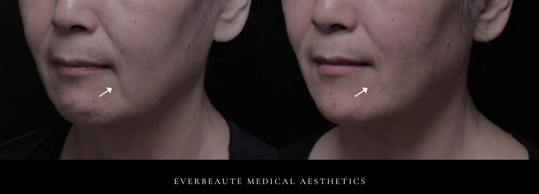 鳳凰電波 凝境美學 曾繁聞醫師 于曉恩醫師 台北醫美 大安區 緊緻拉提6 鳳凰電波 凝境美學 曾繁聞醫師 于曉恩醫師 台北醫美 大安區 緊緻拉提3 鳳凰電波 凝境美學 曾繁聞醫師 于曉恩醫師 台北醫美 大安區 緊緻拉提2 鳳凰電波 凝境美學 曾繁聞醫師 于曉恩醫師 台北醫美 大安區 緊緻拉提5 鳳凰電波 凝境美學 曾繁聞醫師 于曉恩醫師 台北醫美 大安區 緊緻拉提4 輪廓線 眼周細紋