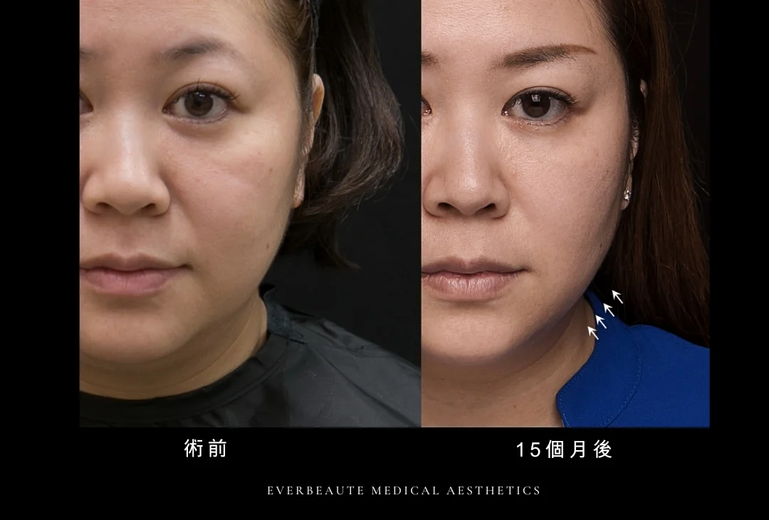 鳳凰電波 凝境美學 曾繁聞醫師 于曉恩醫師 台北醫美 大安區 緊緻拉提2 鳳凰電波 凝境美學 曾繁聞醫師 于曉恩醫師 台北醫美 大安區 緊緻拉提5 鳳凰電波 凝境美學 曾繁聞醫師 于曉恩醫師 台北醫美 大安區 緊緻拉提4 輪廓線 眼周細紋1