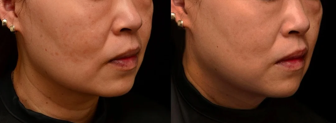 肝斑與色素沈澱是難治的黑斑，矽谷電波sylfirm x是少數擁有肝斑治療適應症的養膚療程淡斑案例，透過修復肌膚基底膜、改善紫外線受損細胞，除斑淨白 台北大安區凝境美學診所 真實案例效果