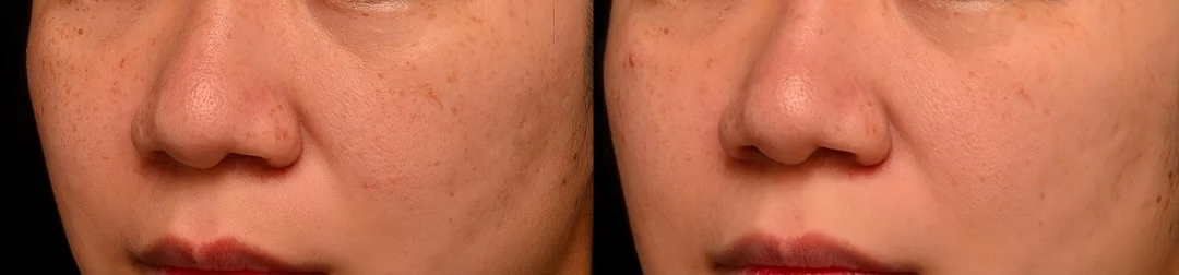 曬斑 雀斑 黑斑 新一代矽谷電波sylfirm x淡斑案例 除斑淨白台北大安區凝境美學診所 真實案例效果