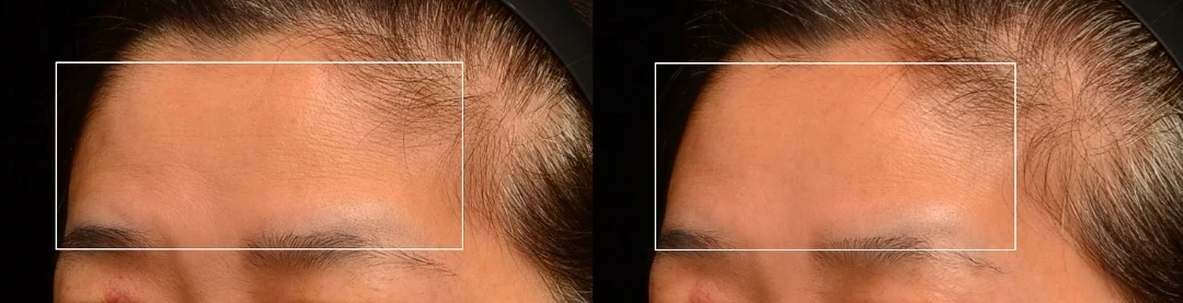 矽谷電波Sylfirm X改善抬頭紋案例