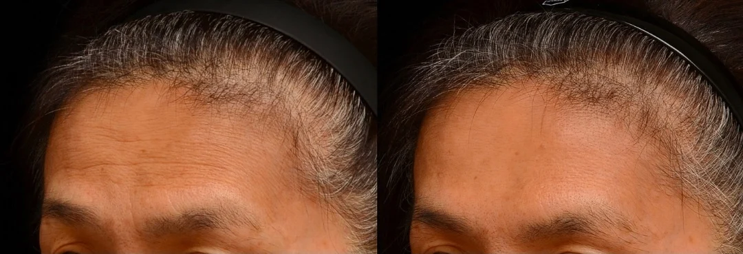 
（上圖的wordpress替代文字 (Alt Text)：水光針保濕玻尿酸合併肉毒素改善抬頭紋案例