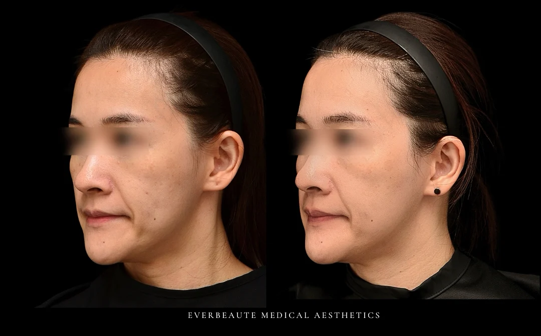 台北大安區凝境美學診所于曉恩醫師真實案例效果 合併皮秒雷射除斑淨白 海飛秀二代Syndeo深層清潔保濕 果酸換膚 改善小姐的黑斑 曬斑 肝斑 老人斑