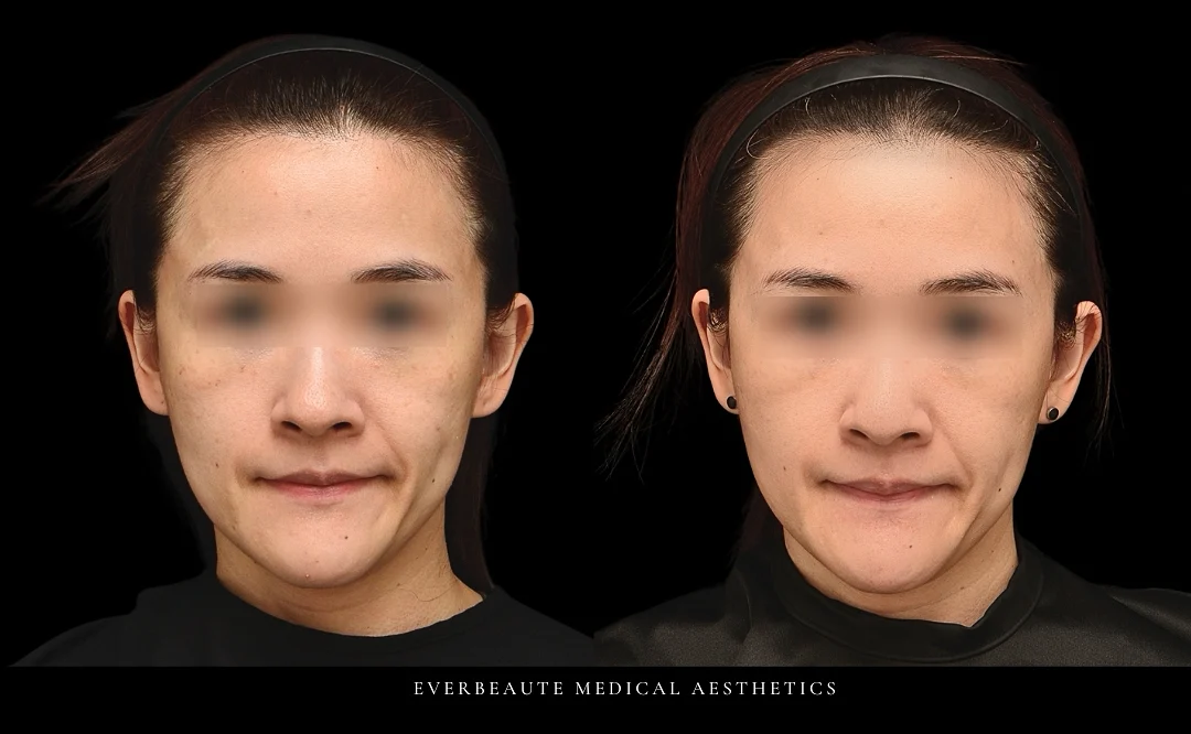 台北大安區凝境美學診所于曉恩醫師真實案例效果 合併皮秒雷射除斑淨白 海飛秀二代Syndeo深層清潔保濕 果酸換膚 改善小姐的黑斑 曬斑 肝斑 老人斑