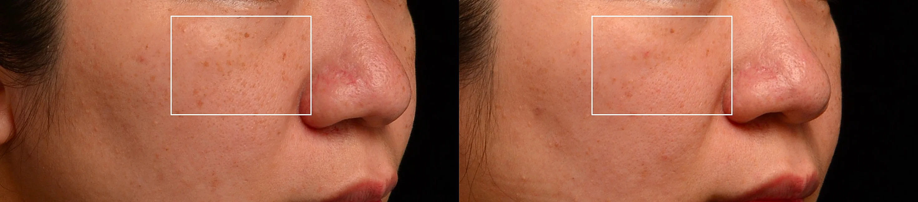 曬斑 雀斑 黑斑 新一代矽谷電波sylfirm x淡斑案例 除斑淨白台北大安區凝境美學診所 真實案例效果