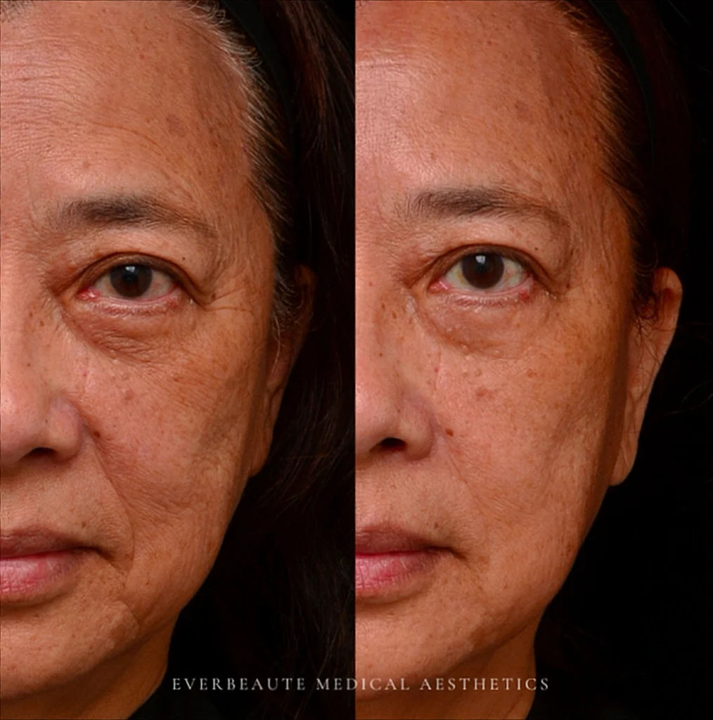 水光針 保濕針 真實案例效果 玻尿酸長效深層保濕 改善暗沈 乾燥 皺紋 細紋