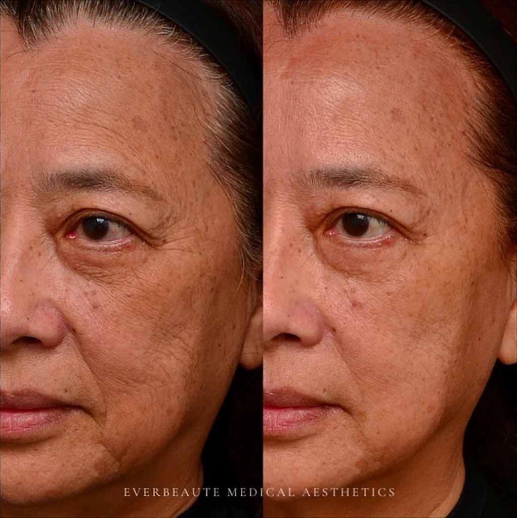 水光針 保濕針 真實案例效果 玻尿酸長效深層保濕 改善暗沈 乾燥 皺紋 細紋