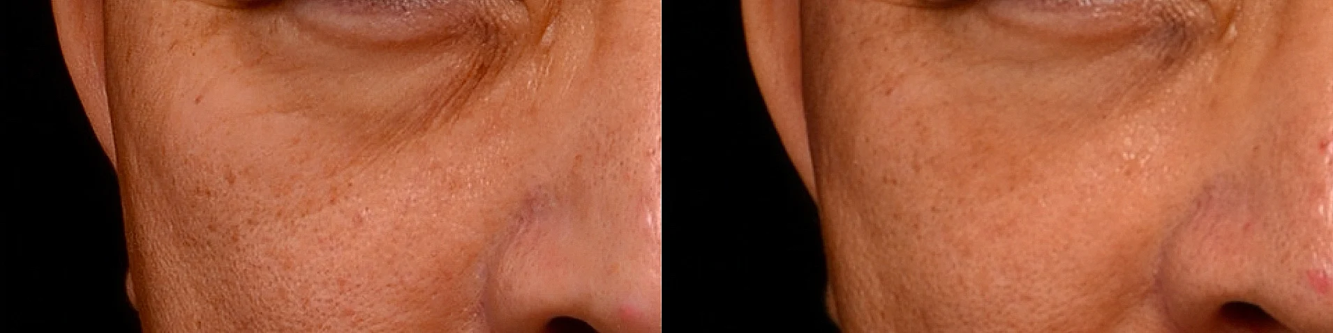 水光針 保濕針 改善眼下細紋 真實案例效果