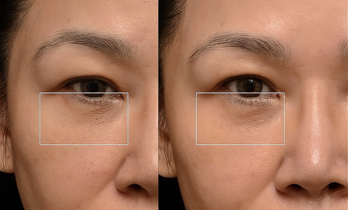 逆時針Profhilo原廠指定凝境美學診所曾繁聞院長示範注射案例，皮膚科醫學會年會演講：改善眼下細紋