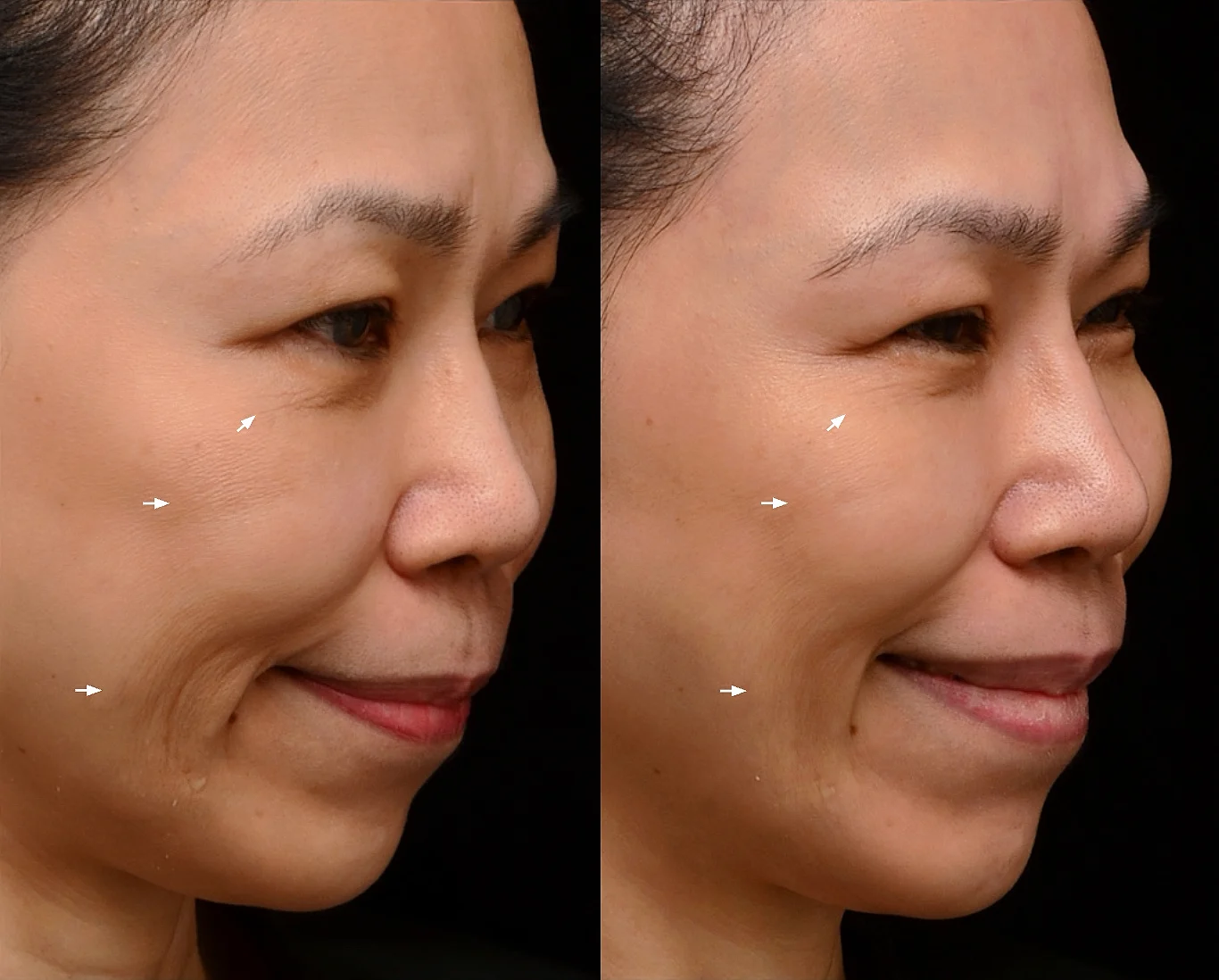 逆時針Profhilo原廠指定凝境美學診所皮膚專科曾繁聞院長 醫美專科于曉恩院長示範注射教學案例，發表於皮膚科醫學會年度學術年討會。逆時針結合高分子量與低分子量玻尿酸，刺激膠原蛋白與彈力蛋白增生，活化細胞，緊緻肌膚、改善鬆弛，深層鎖水保濕，膚質透亮細緻，淡化眼下細紋，沒有傳統填充失敗所擔心的饅化、變形、位移等副作用、後遺症，效果自然
