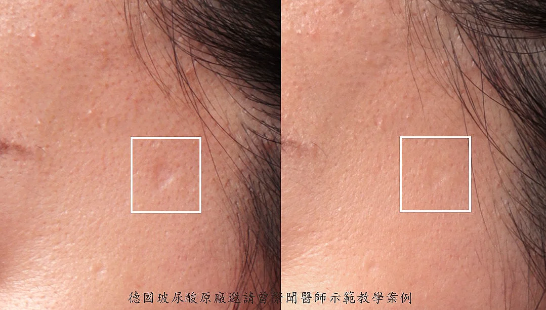 水痘疤凹疤治療 玻尿酸注射，一次治療快速達到明顯進步