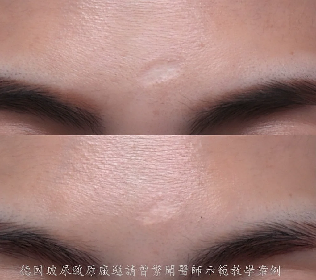 傷疤痕 凹疤治療 玻尿酸注射，一次治療快速達到明顯進步