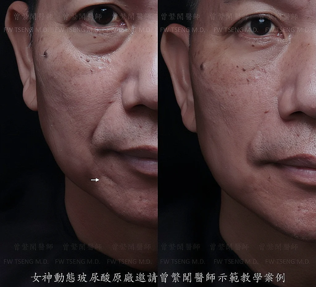 外傷疤痕 凹疤治療 女神動態玻尿酸注射，一次治療快速達到明顯進步
