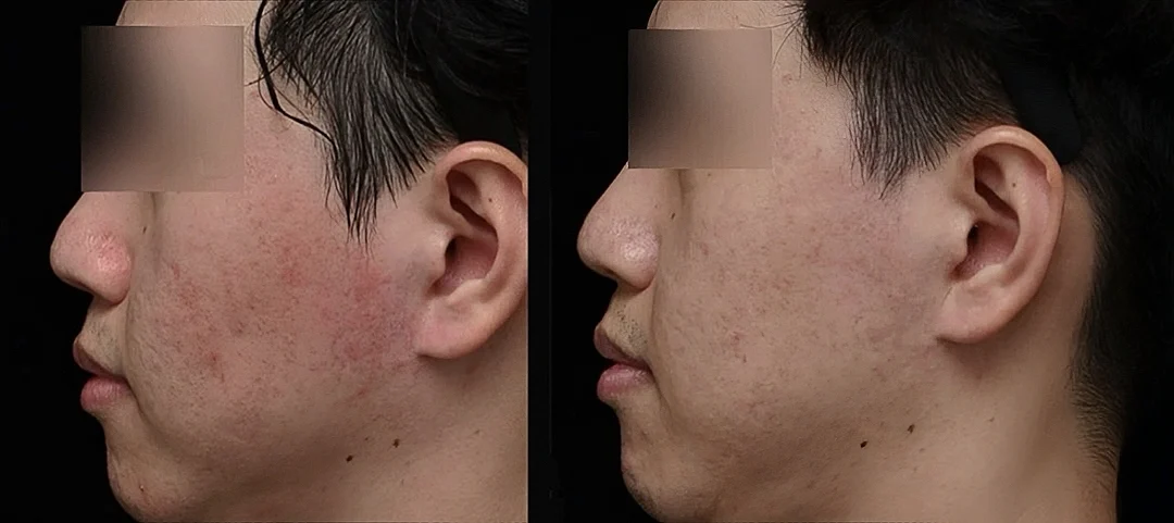 皮膚泛紅 酒糟膚質改善 矽谷電波 slyfirm x 凝境美學診所真實案例