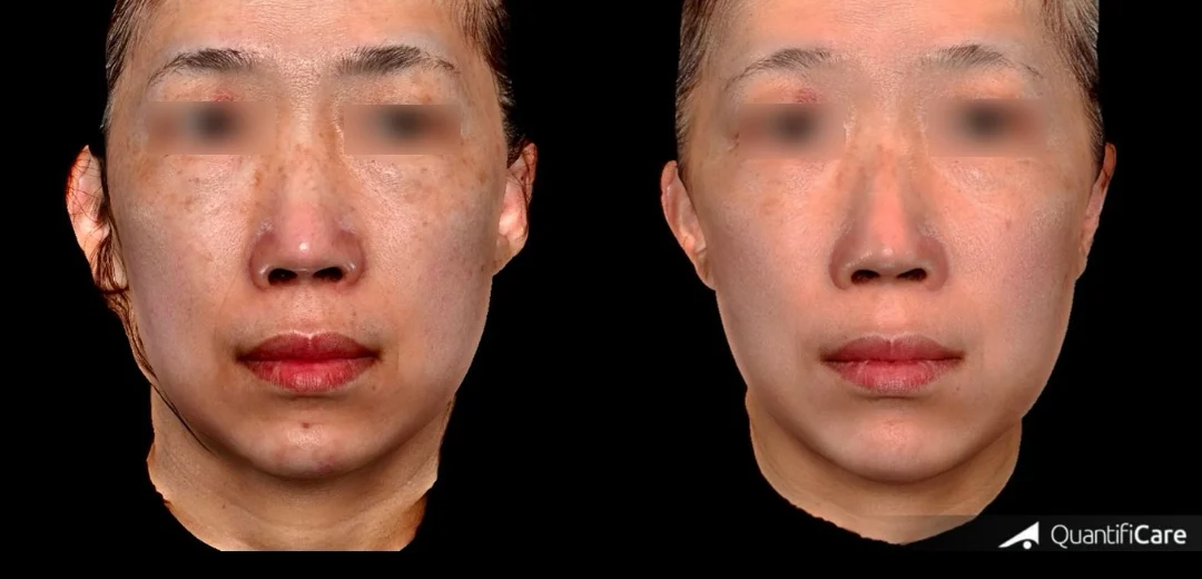 這位小姐除了曬斑以外，還有難以治療的肝斑與色素沈澱，矽谷電波sylfirm x是少數擁有肝斑治療適應症的養膚療程，透過修復肌膚基底膜、改善紫外線受損細胞，他的黑色素淡化以外，膚質也更細緻均勻透亮，台北大安區凝境美學診所 真實案例效果