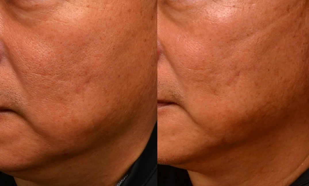 水光針 保濕針 真實案例效果 玻尿酸長效深層保濕 改善毛孔粗大暗沈 乾燥 皮膚亮澤