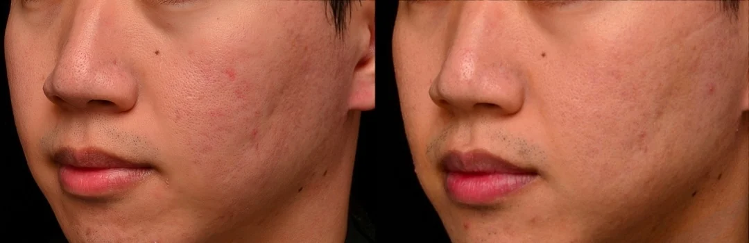 痘疤凹疤、毛孔粗大 矽谷電波 slyfirm x 凝境美學診所真實案例