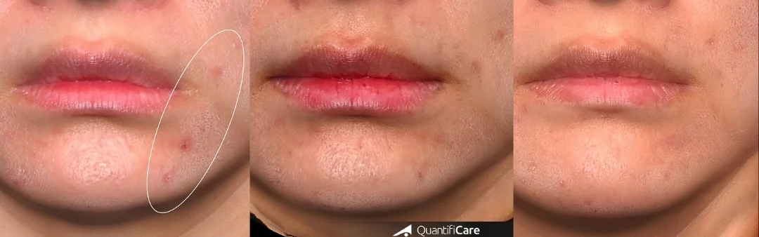 新一代矽谷電波sylfrim x改善紅痘疤、去痘印，1次與2次治療後退紅，台北大安區凝境美學診所曾繁聞醫師于曉恩醫師真實案例效果