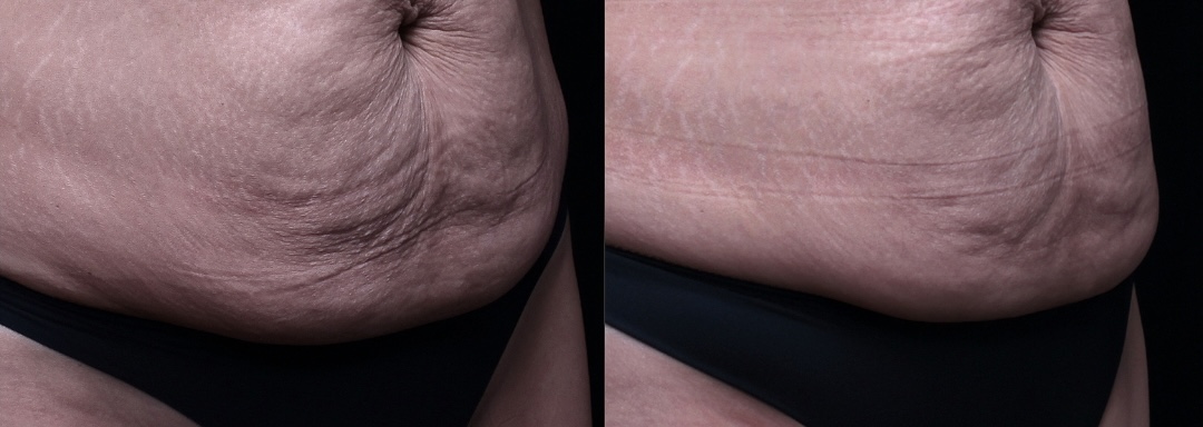 二代美國音波合併再生針Radiesse改善產後媽媽肚子鬆弛皺紋案例