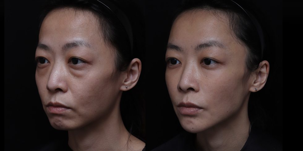 凝境美學診所無痕拉提