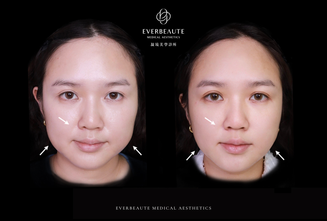 凝境美學美國音波案例＿李凱蒂 美國超聲刀 ulthera ultherapy