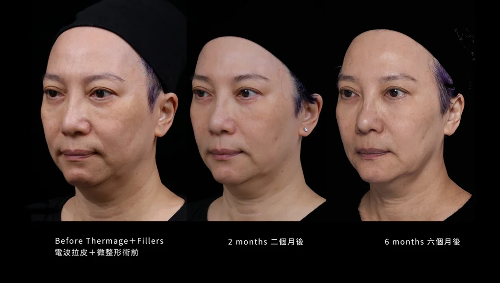 電波拉皮 + 3D聚左旋乳酸 + 玻尿酸術02