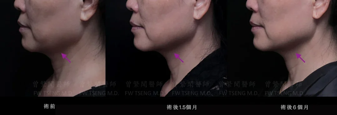 鳳凰電波原廠邀請 曾繁聞醫師教學示範案例：下半臉輪廓鬆弛，下顎線條緊緻