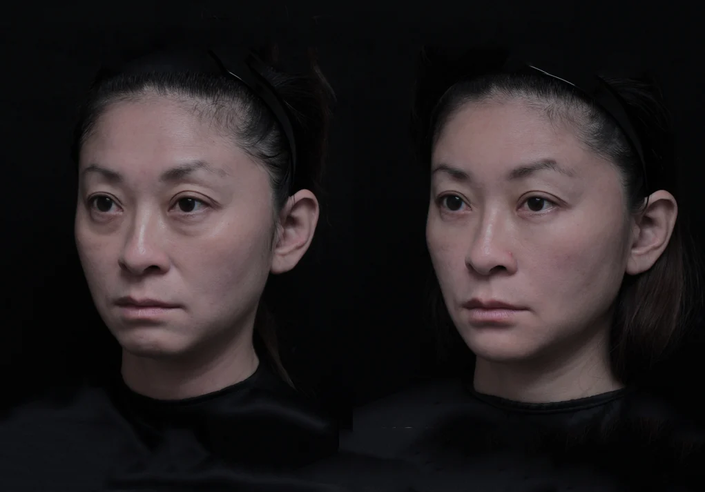 41歲 櫃姐好累 ｜ 淚溝 眼袋 法令紋 額頭扁平 下巴後縮 上眼窩凹陷左45