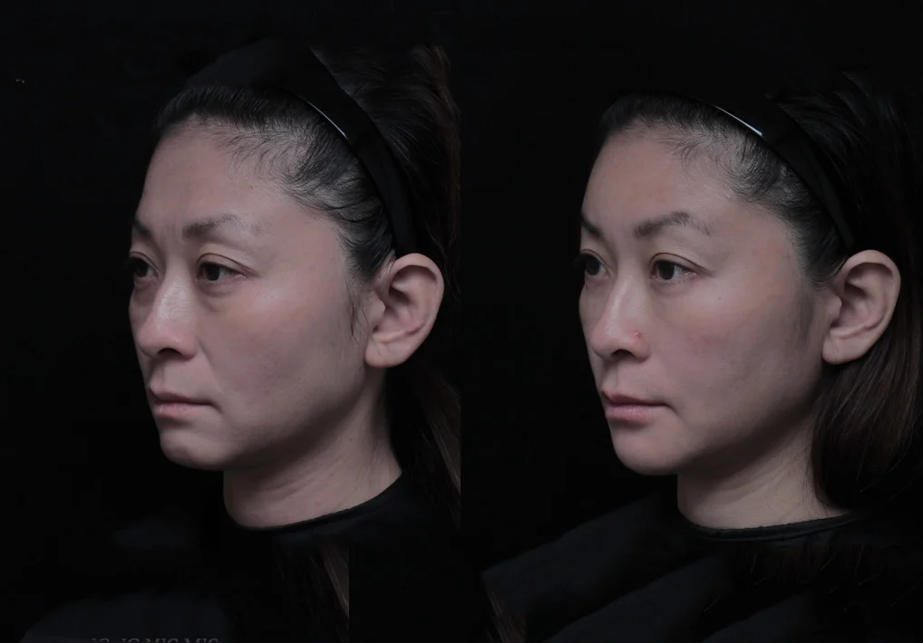 41歲 櫃姐好累 ｜ 淚溝 眼袋 法令紋 額頭扁平 下巴後縮 上眼窩凹陷左90