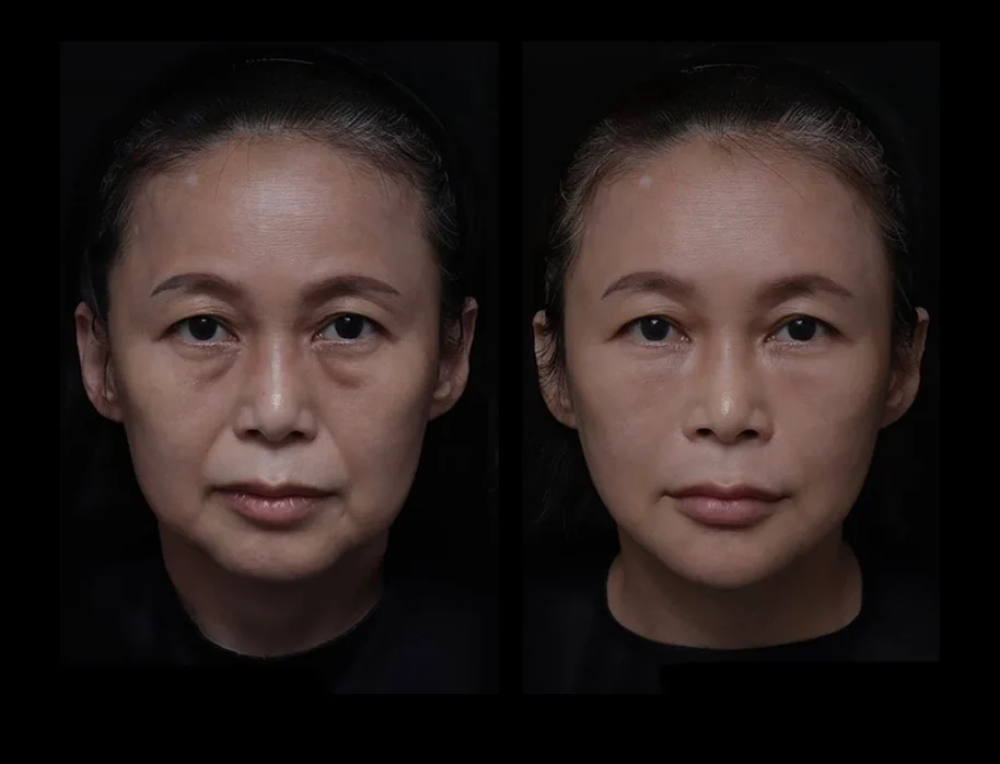 4合1微創拉提 | 51歲女 嘴邊肉 法令紋下垂 重度眼袋 | 音波+膠原蛋白增生+玻尿酸+肉毒素
