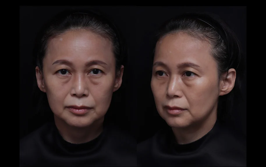 4合1微創拉提 | 51歲女 嘴邊肉 法令紋下垂 重度眼袋 | 音波+膠原蛋白增生+玻尿酸+肉毒素2