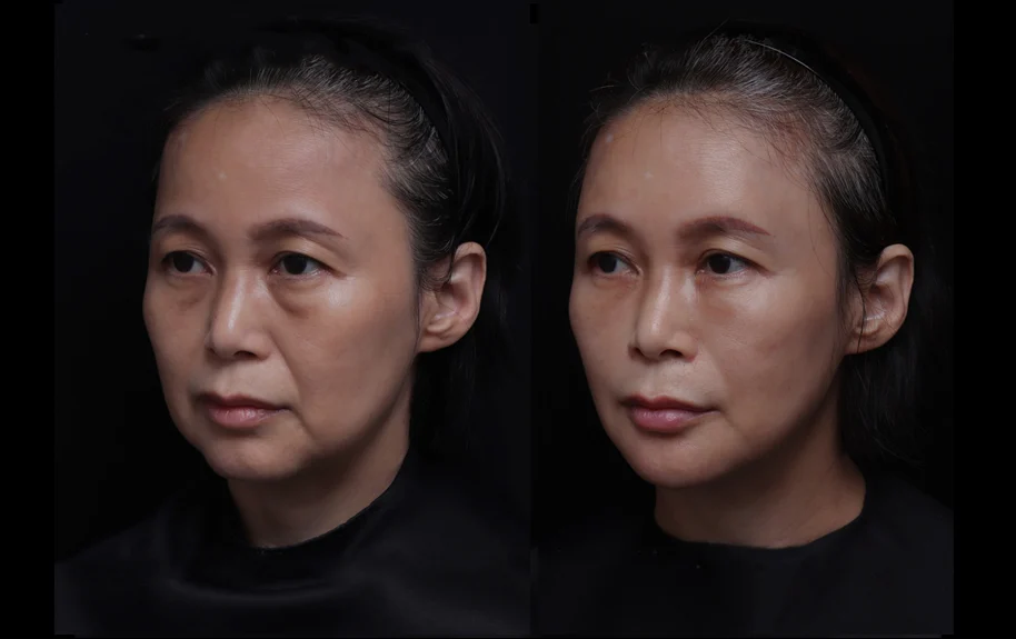 4合1微創拉提 | 51歲女 嘴邊肉 法令紋下垂 重度眼袋 | 音波+膠原蛋白增生+玻尿酸+肉毒素3
