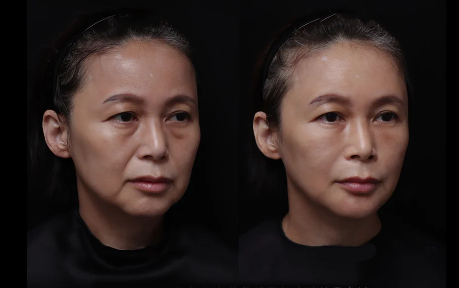 合1微創拉提 | 51歲女 嘴邊肉 法令紋下垂 重度眼袋 | 音波+膠原蛋白增生+玻尿酸+肉毒素4