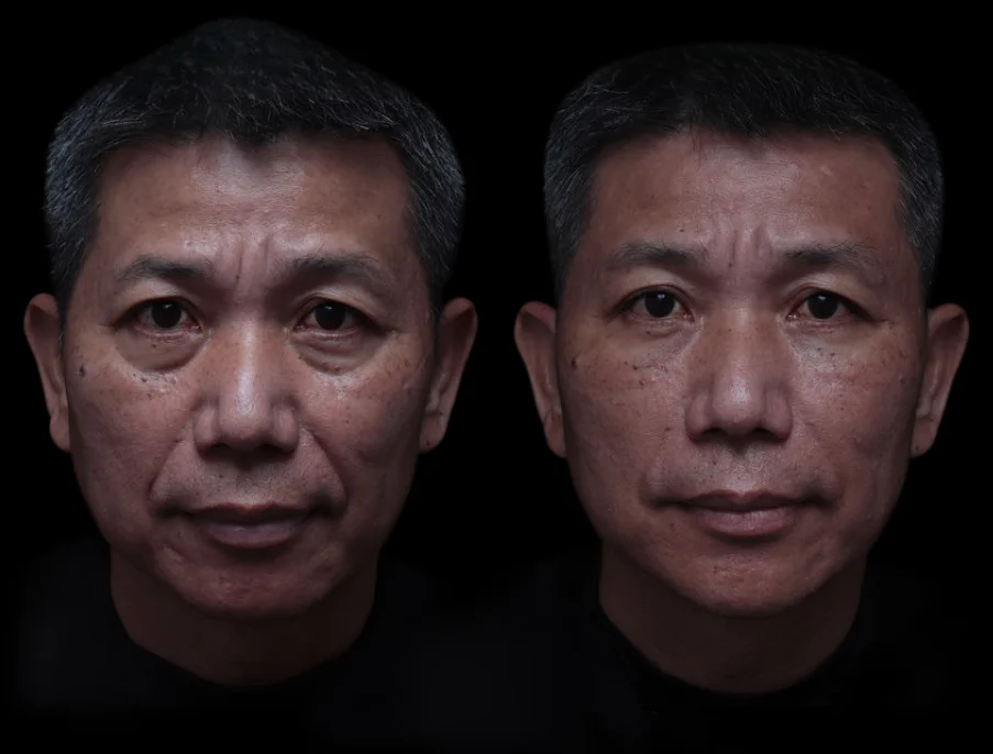 玻尿酸 男性醫美 男性微整