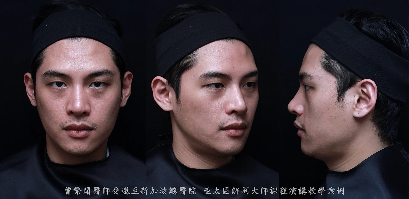 黑眼圈 淚溝 雙下巴