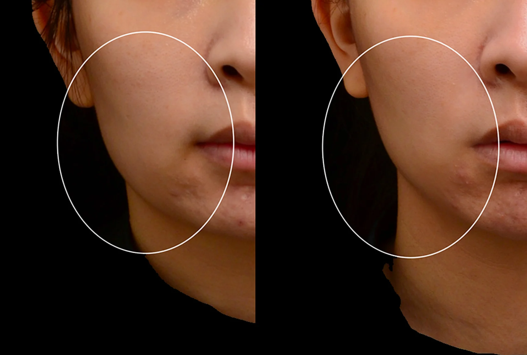 凝境美學真診所美國音波第二代ultherapy prime極透＋拉提 真實案例 木偶紋 美版超聲刀
