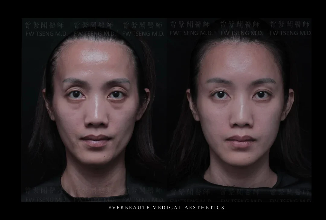 下半臉氣質殺手 下巴後縮 中年婦女 澎潤 暴牙 太陽穴額頭凹陷 上眼窩凹